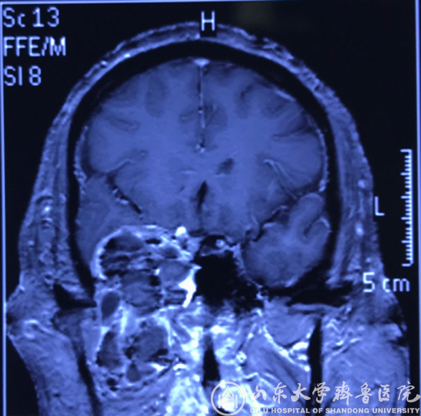 艺高人胆大 颅底咽旁巨大肿瘤内镜下巧切除